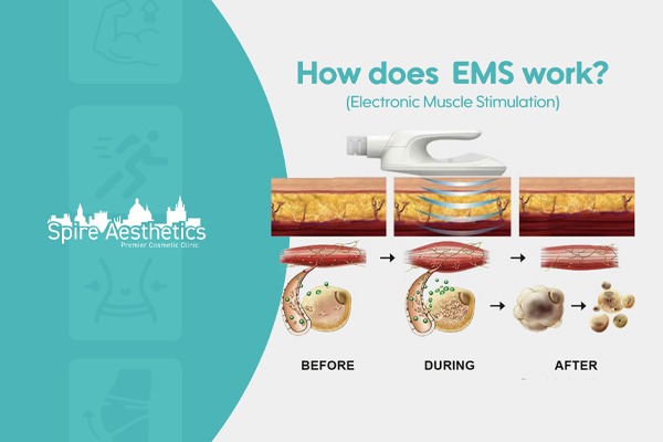 EMS treatment for post pregnancy weight loss treatment St Neots