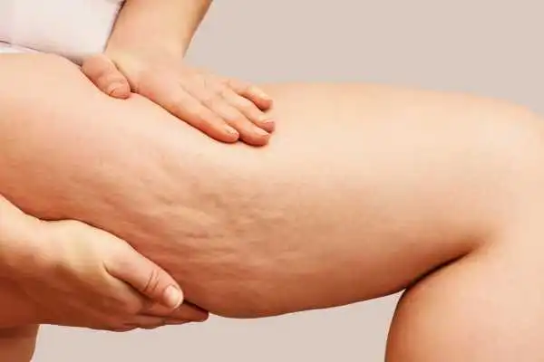 Image of woman showing leg with cellulite St Neots