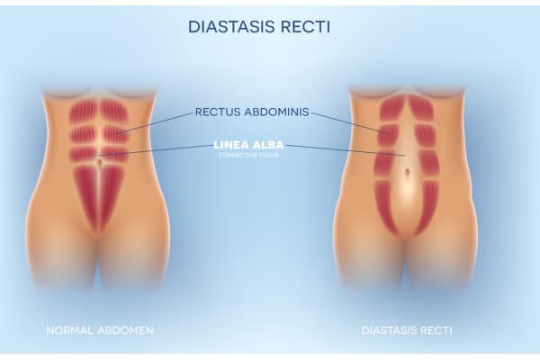 What Non-Surgical Options Are Available for Diastasis Recti St Neots?