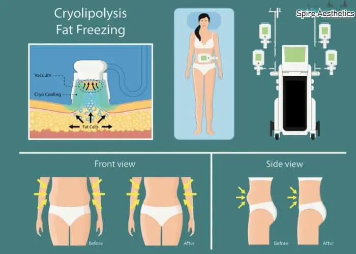 Fat freezing treatment St Neots benefits for competitions to remove stubborn fat deposits.