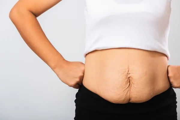 Image of a woman's stomach after weight loss with sagging skin following a gastric band St Neots