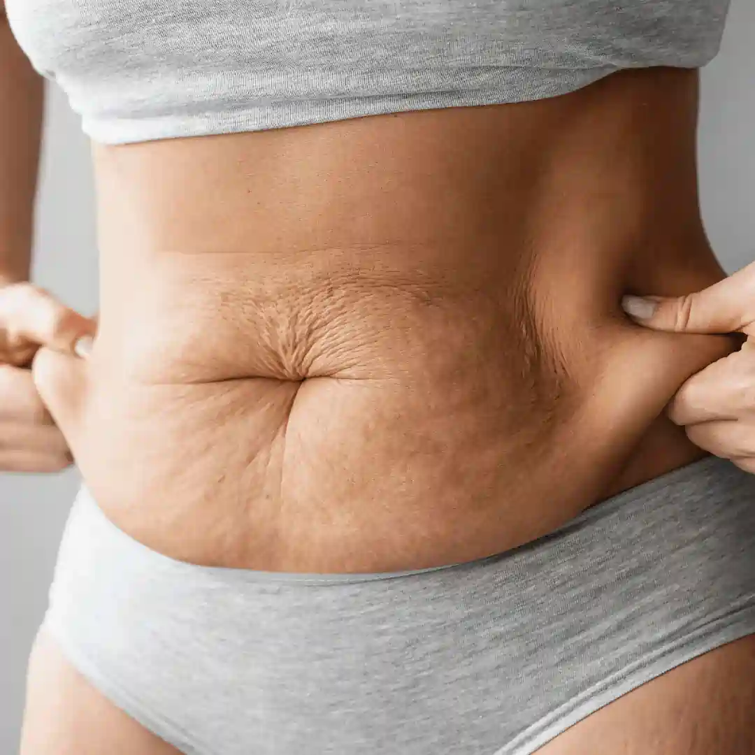 Is It Normal to Have Loose Skin After Pregnancy St Neots?