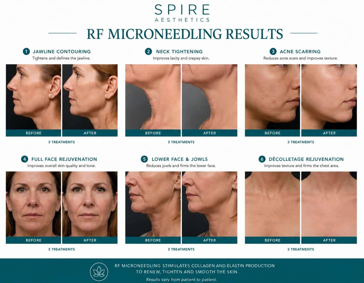 RF Microneedling Skin tightening St Neots results