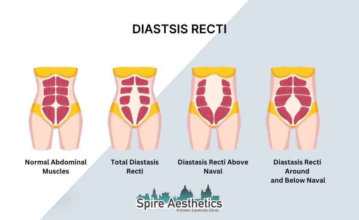 Is Non-Surgical Diastasis Recti Treatment Right for You? Common Concerns Answered St Neots